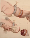Charles Bell, 'Illustrations of the great operations of surgery, '1821